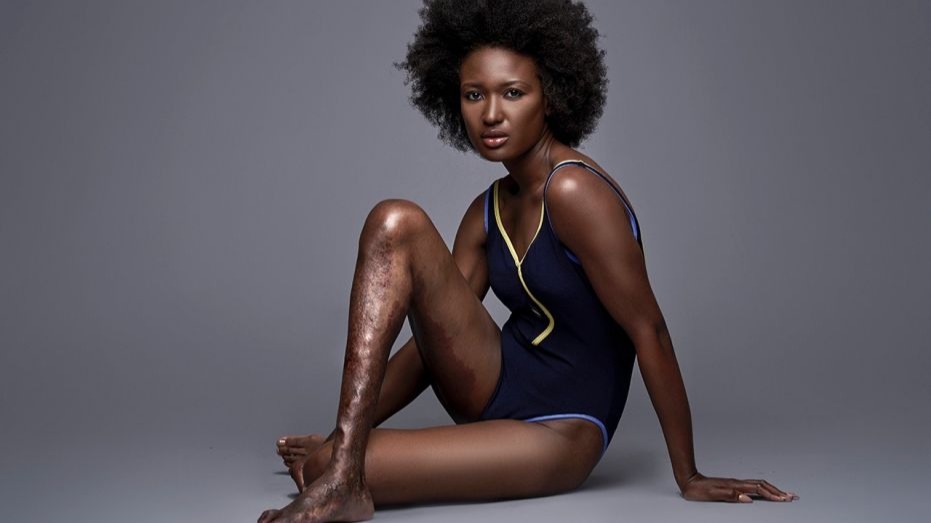 For years, Berlange Presilus and her family didn’t get a medical diagnosis about her leg, though it had caused her pain ever since she was a child. Today, Berlange is a thriving model who not only struts her stuff (as a Klippel Trenaunay Syndrome survivor), but shows others that there is beauty in finding your power. She shares with Yahoo Lifestyle: “I came a long way, from disliking parts of my body to loving every bit of it, especially my affected leg. I am so happy to have finally made peace with this amazing body of mine.”And if you needed another reminder that we’re all works of art, Berlange has some inspiring words: “Inherently, everything created by the almighty God is created with utmost perfection and beauty. Who are we as simple humans to judge or criticize such masterpieces? We are all created beautifully. Beauty is in everyone, because we are all a true manifestation of beauty.”